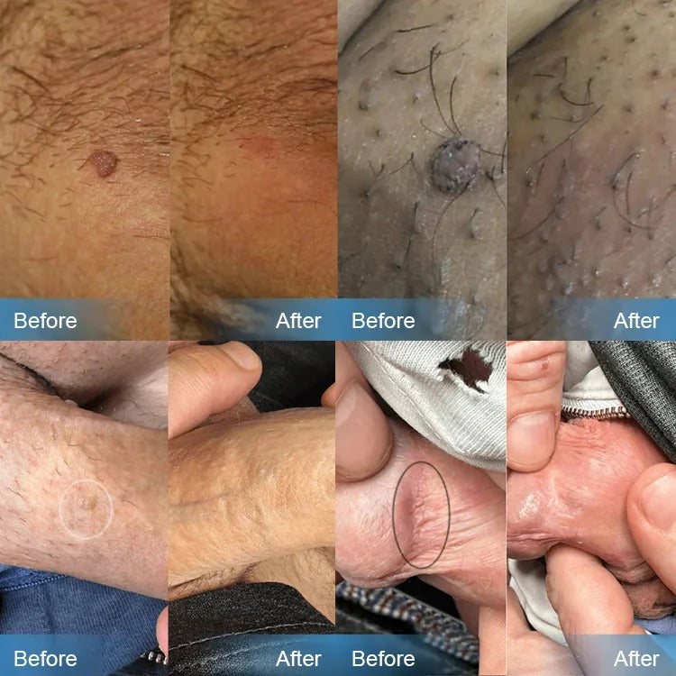 NNLP Smooth Skin Wart Removal Cream