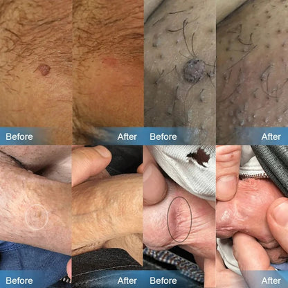 NNLP Smooth Skin Wart Removal Cream