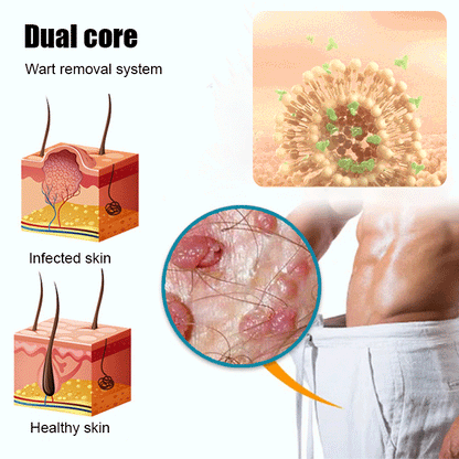 NNLP Smooth Skin Wart Removal Cream