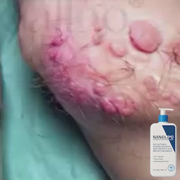 NNLP Smooth Skin Wart Removal Cream